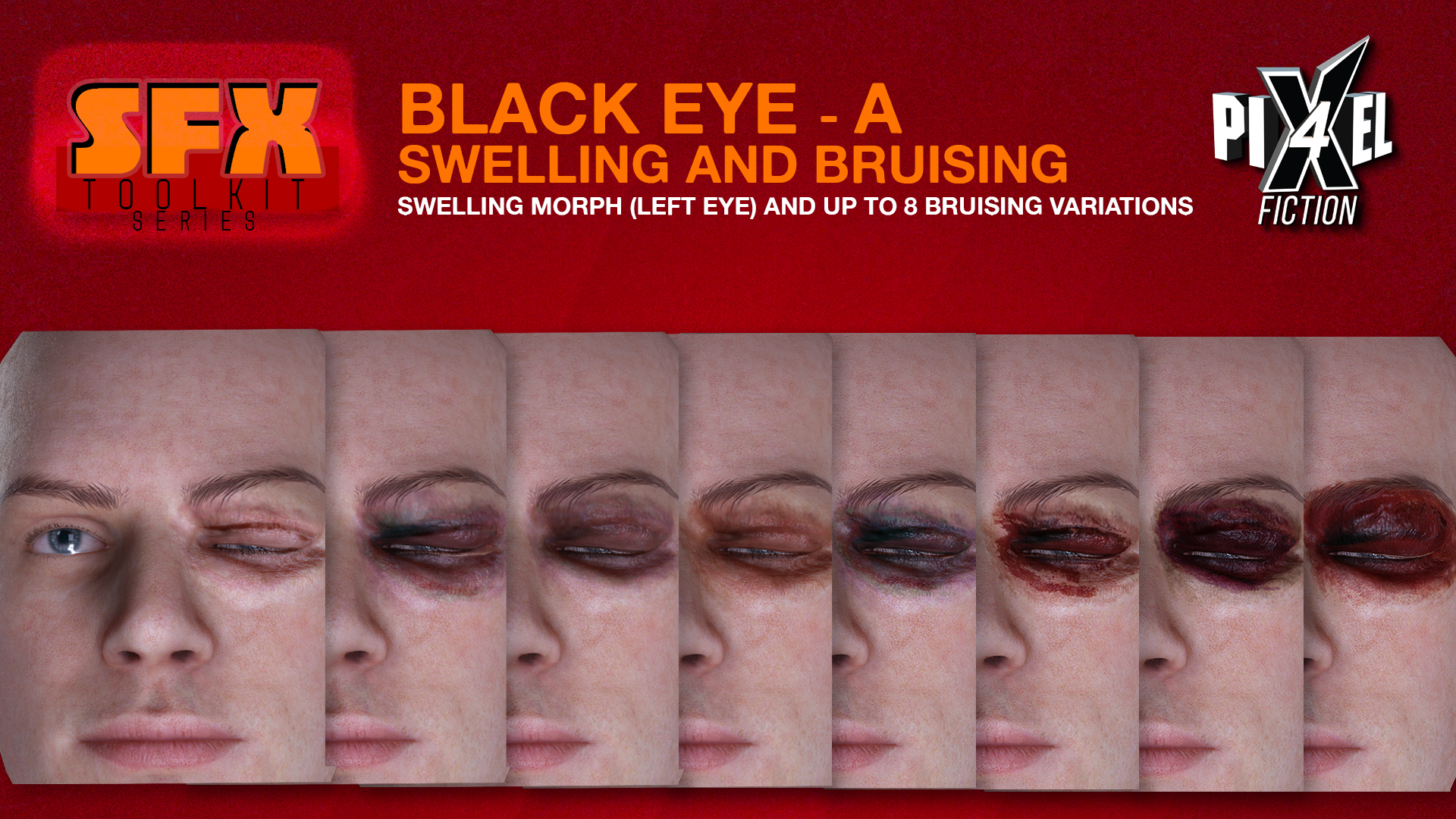 Black Eye A - Swelling and Bruising
